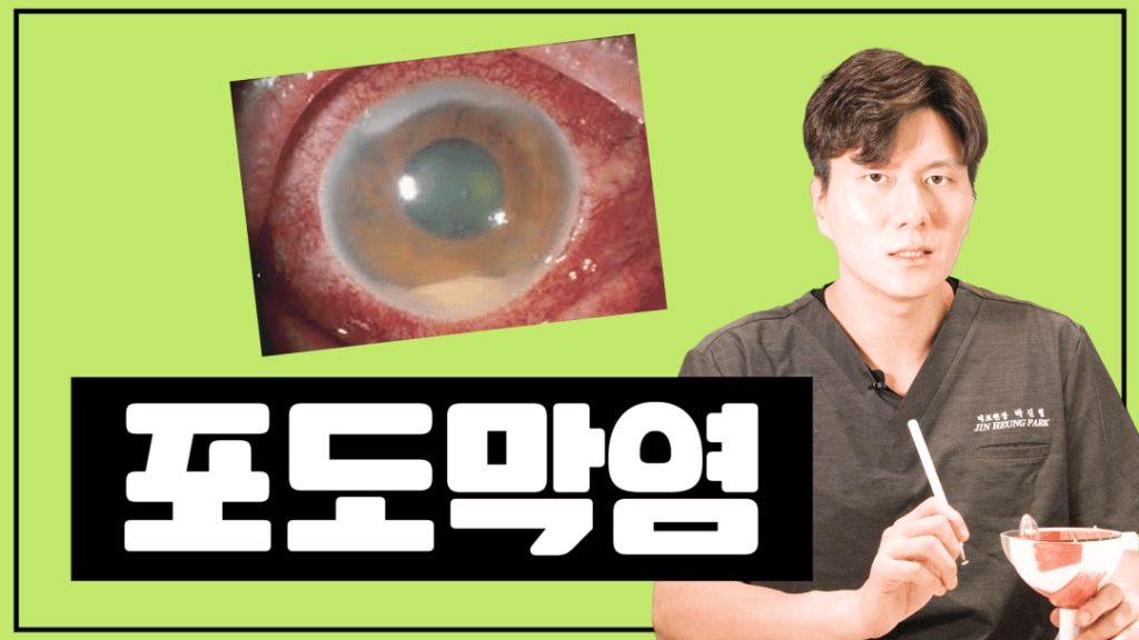 포도막염 증상, 포도막염 원인, 포도막염 재발, 피부 건선, 류마티스 질환, 강직성 척추염, 반응성 관절염, 건선, 관절염, 베체트병