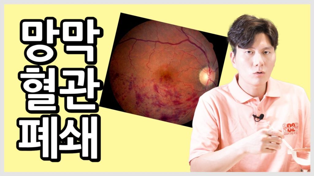 망막 혈관 폐쇄, 망막수술, 시력 저하, 눈 중풍