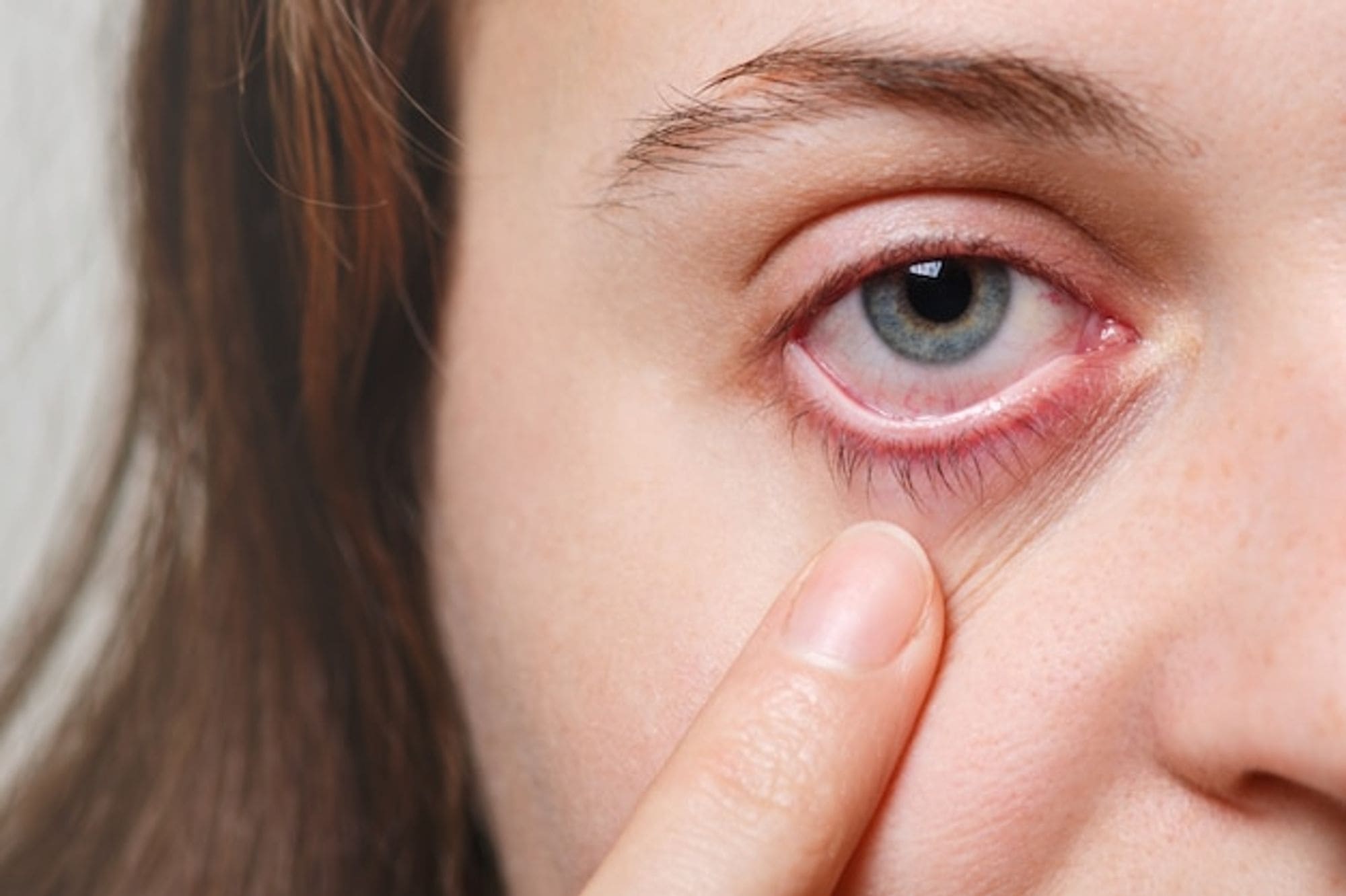 “갑자기 빨개진 눈?” 눈 충혈 원인 5가지 및 치료법!