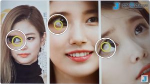 결막모반, 복합모반, 안구미백, 눈에 점, 결막모반 제거