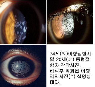 아벨리노 각막이상증 치료, 한쪽 눈이 뿌옇게 보여요, 시력교정술 부작용, 유전 질환, 각막혼탁 초기