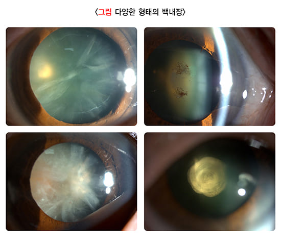 난시 교정, ICL 렌즈 가격, 렌즈삽입 부작용, 렌즈삽입술,  교정 렌즈