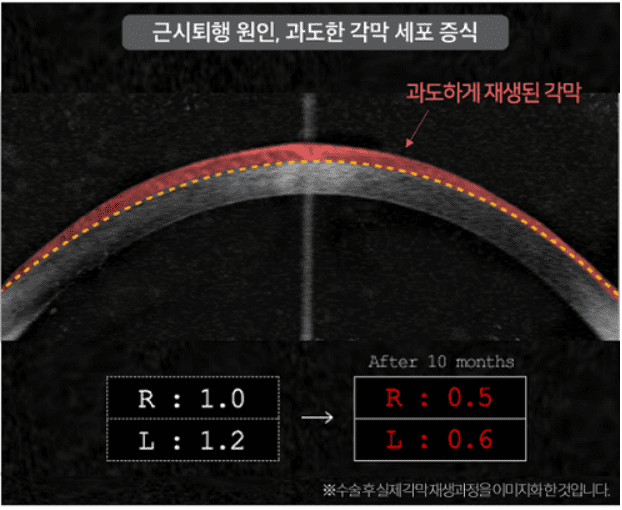각막강화술 필요한 사람의 특징 3가지 | 성모진안과