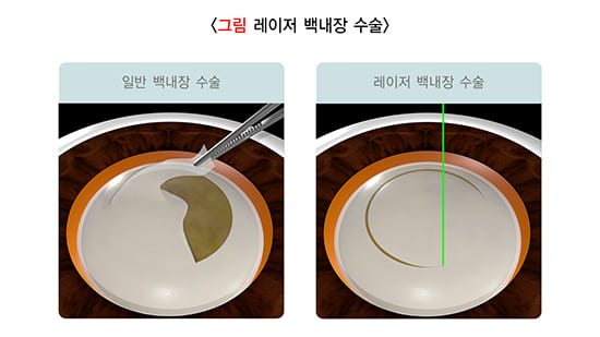 백내장 수술 후 시력변화, 백내장 수술 후 부작용, 백내장 치료, 백내장 수술 과정, 백내장 수술 방법