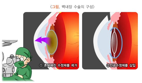 백내장 수술후 정상생활까지 회복 기간, 백내장 수술후 머리감기, 백내장 수술후 선글라스, 백내장 수술후 시력변화, 백내장 수술 후 부작용