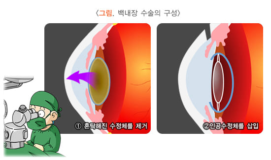 백내장 수술 후 시력변화, 백내장 수술 후 부작용, 백내장 치료, 백내장 수술 과정, 백내장 수술 방법