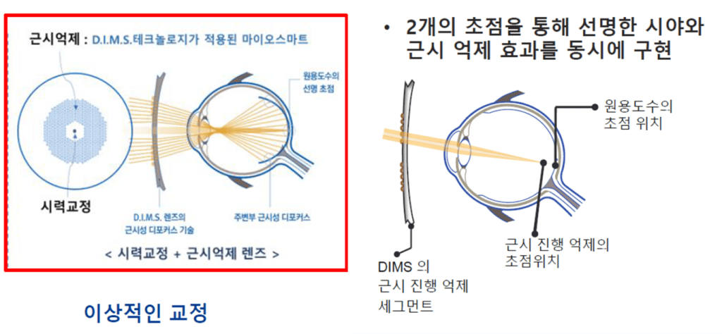 고도 근시, 근시 안경, 근시 원인, 안경 도수, 마이오스마트