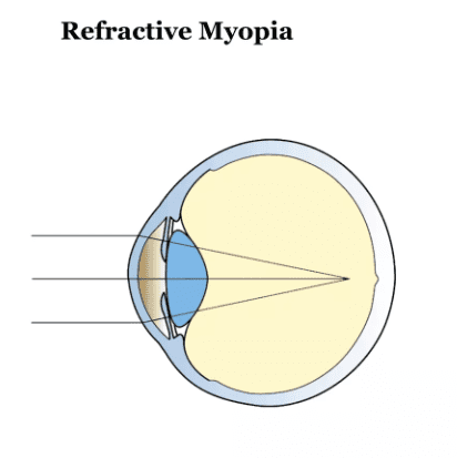 고도 근시, 근시 안경, 근시 원인, 안경 도수, 마이오스마트