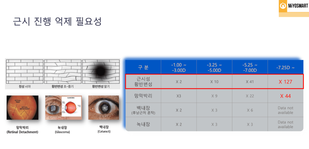 고도 근시, 근시 안경, 근시 원인, 안경 도수, 마이오스마트