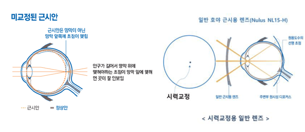 고도 근시, 근시 안경, 근시 원인, 안경 도수, 마이오스마트