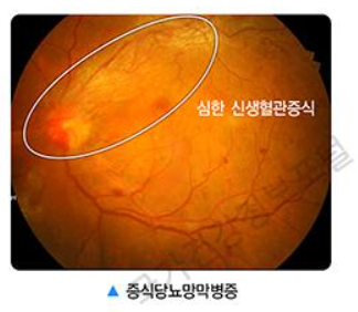 당뇨망막병증, 당뇨병 금기 음식, 당뇨병 합병증, 당뇨망막병증 초기 증상, 당뇨에 좋은 음식