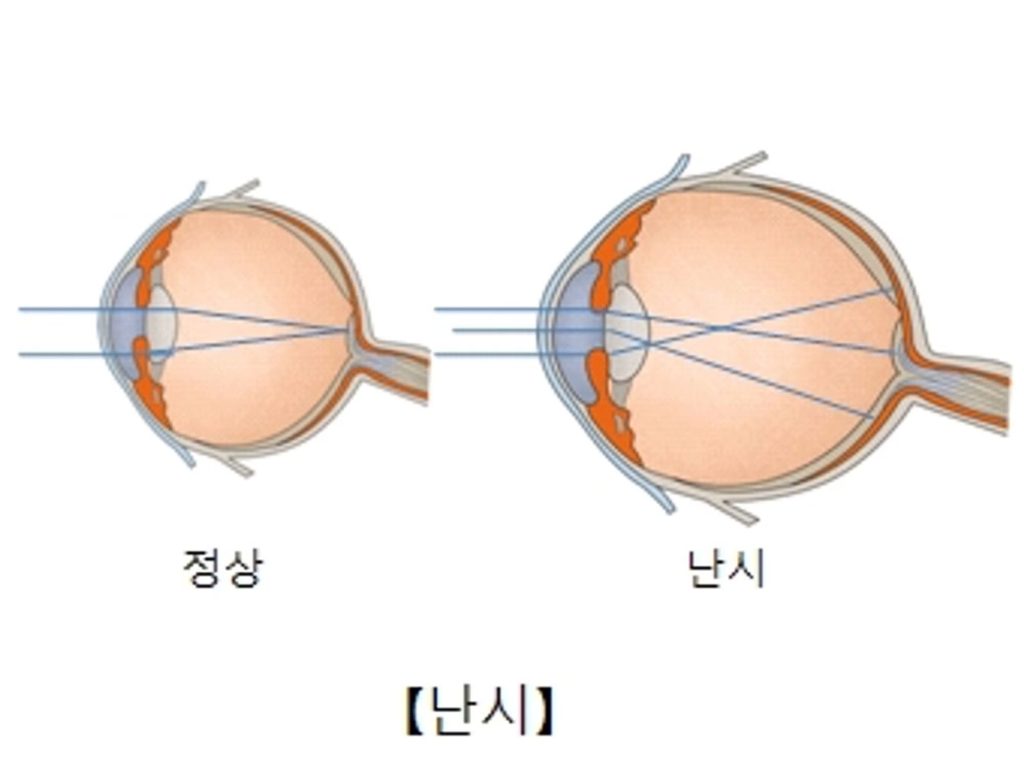 난시가 보는 세상, 근시 난시, 난시 치료법, 난시 빛 번짐, 라식 라섹 안되는 눈