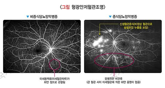 당뇨망막병증, 당뇨병 금기 음식, 당뇨병 합병증, 당뇨망막병증 초기 증상, 당뇨에 좋은 음식