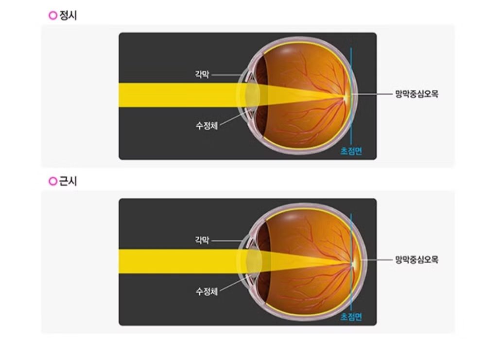 근시 뜻, 근시 원시, 고도 근시 기준, 고도 근시 라섹, 라식 라섹 차이