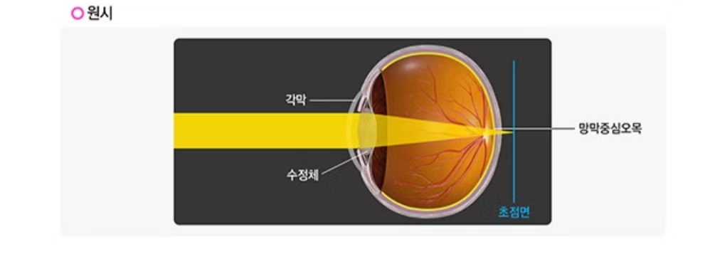 근시 뜻, 근시 원시, 고도 근시 기준, 고도 근시 라섹, 라식 라섹 차이