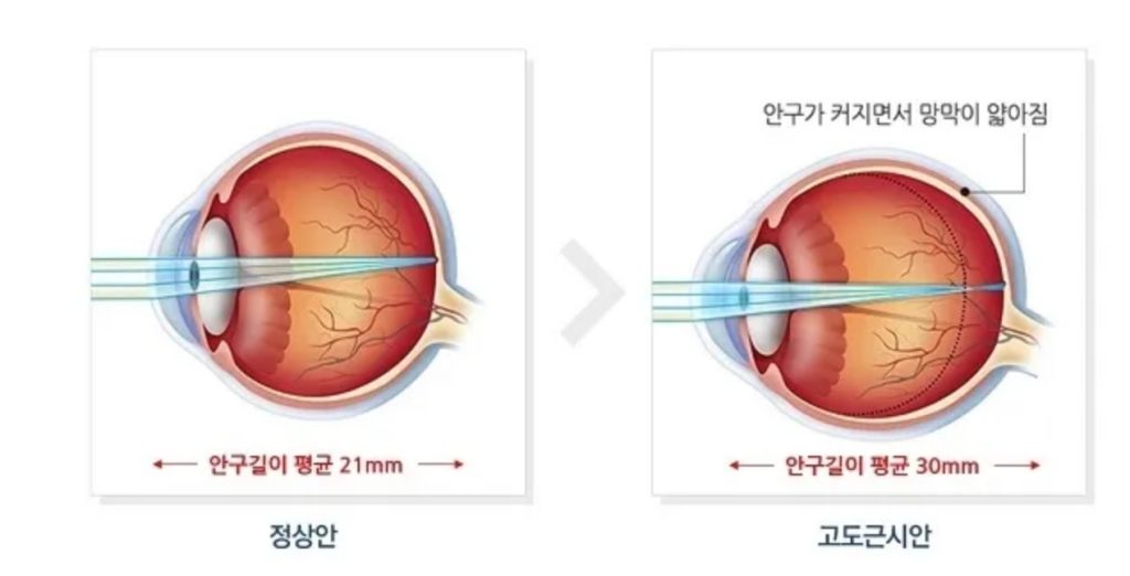 근시 뜻, 근시 원시, 고도 근시 기준, 고도 근시 라섹, 라식 라섹 차이