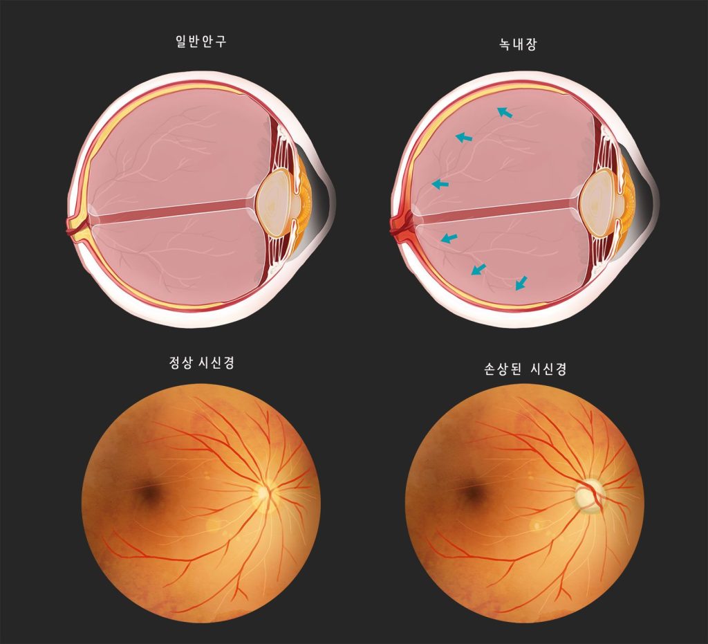 녹내장 실명 확률, 녹내장 시야, 녹내장 초기 증상, 녹내장 원인, 녹내장 예방
