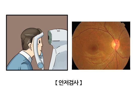 녹내장 실명 확률, 녹내장 시야, 녹내장 초기 증상, 녹내장 원인, 녹내장 예방