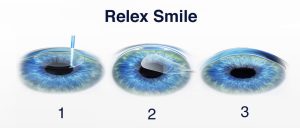 스마일라식 하지마, 스마일라식 선글라스, 스마일라식 한쪽 눈 흐림, 스마일라식 회복, 스마일라식 가격