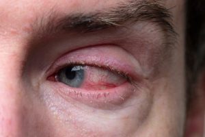 안구건조증 해결, 안구건조증 치료, 안구건조증 인공눈물 추천, 마이봄샘 청소, 눈꺼풀염