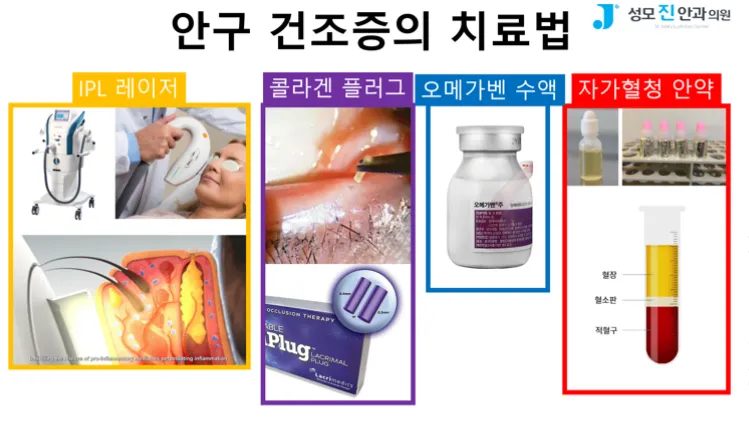 자고 일어나도 눈이 피곤, 안과 검진, 안구건조증 해결 방법, 눈 좋아지는 법, 안구건조증 증상