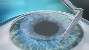 라섹 자외선 차단 안경, 라섹 선글라스 언제까지, 선글라스 추천, 선글라스 브랜드, 자외선 차단 안경 효과