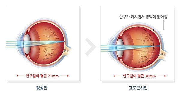 스마일라식 부작용, 아벨리노, 산동검사, 안경도수, 안과 정밀 검사 비용