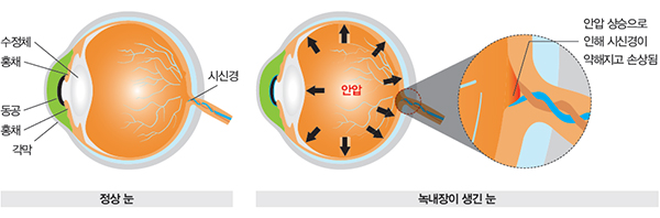 아이링 수술, 아이링 시술, 눈동자 확대, 눈동자 커지는 수술, 각막 손상