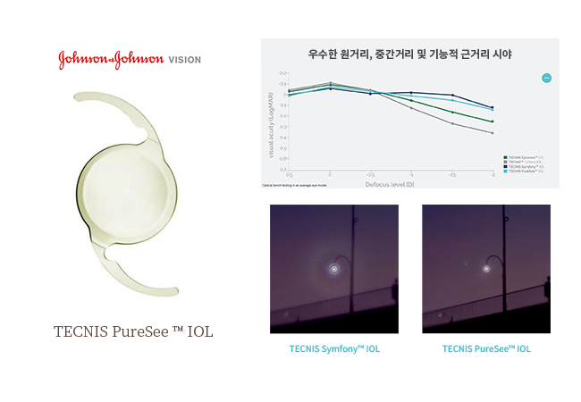 수정체 혼탁, 백내장 초기 사진, 백내장 단초점 후기, 백내장 다초점렌즈 부작용, 단안복시