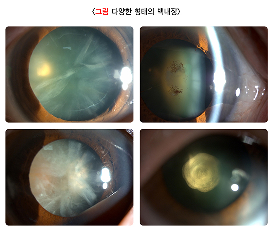 수정체 혼탁, 백내장 초기 사진, 백내장 단초점 후기, 백내장 다초점렌즈 부작용, 단안복시