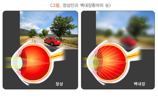 수정체 혼탁, 백내장 초기 사진, 백내장 단초점 후기, 백내장 다초점렌즈 부작용, 단안복시