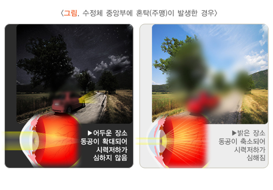 수정체 혼탁, 백내장 초기 사진, 백내장 단초점 후기, 백내장 다초점렌즈 부작용, 단안복시