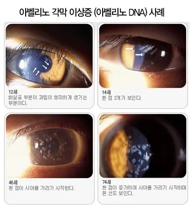 스마일라식 부작용, 아벨리노, 산동검사, 안경도수, 안과 정밀 검사 비용