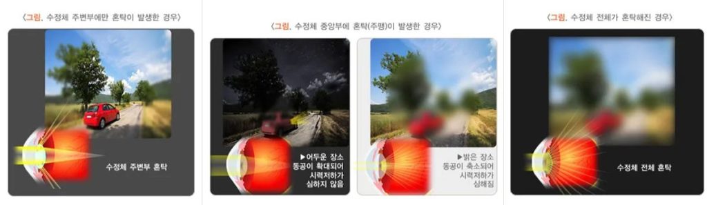 백내장 수술 안하면, 백내장 수술 시기, 백내장 자가 진단, 백내장 시야, 백내장 실명 