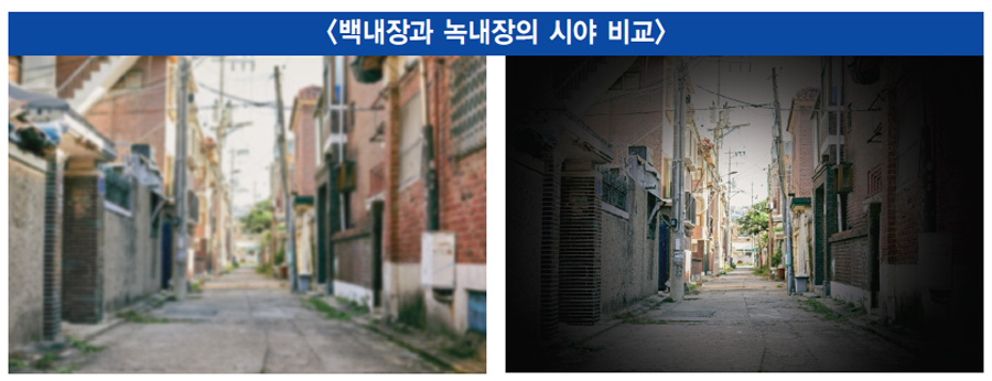 백내장 수술 안하면, 백내장 수술 시기, 백내장 자가 진단, 백내장 시야, 백내장 실명 