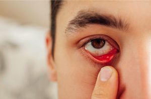 눈 기름샘 청소, 마이봄샘, 눈꺼풀 피지, 눈꺼풀 안쪽 이물감, 안검염