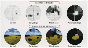녹내장 자가 진단, 녹내장 치료, 녹내장 완치 사례, 녹내장 시야, 녹내장 초기 사진