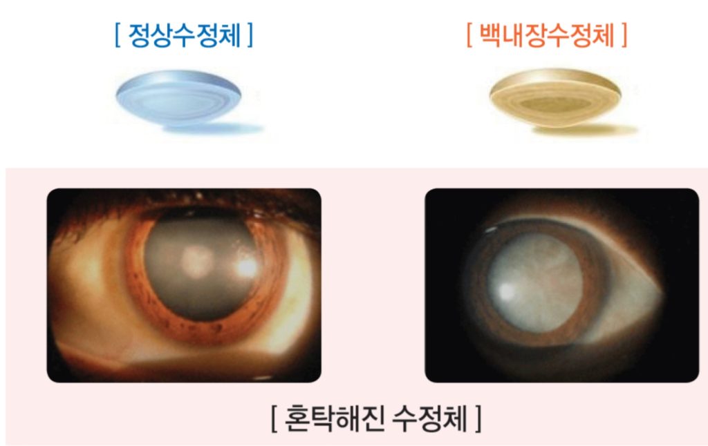 백내장 수술 안하면, 백내장 수술 시기, 백내장 자가 진단, 백내장 시야, 백내장 실명 