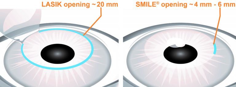 라식 후 렌즈, 렌즈 각막 손상, 라식 회복 기간, 라섹 렌즈, 렌즈 끼면 안되는 눈