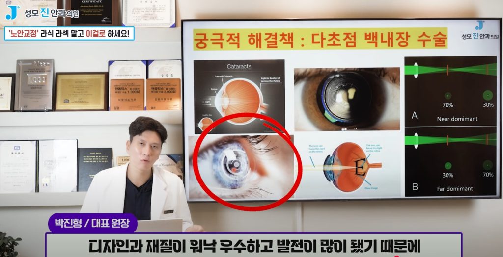 노안 치료, 노안 수술, 노안 증상, 노화 시작 나이, 모노비전