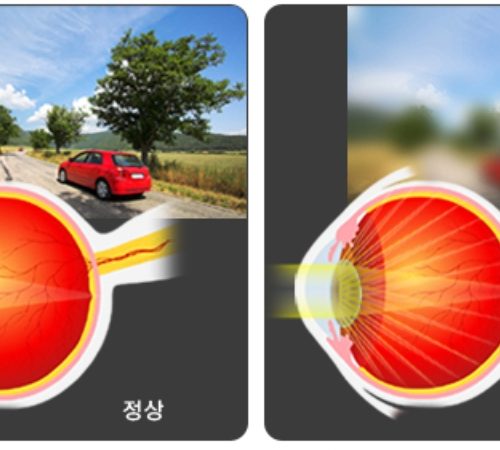 백내장 재수술이 필요한 4가지 상황!