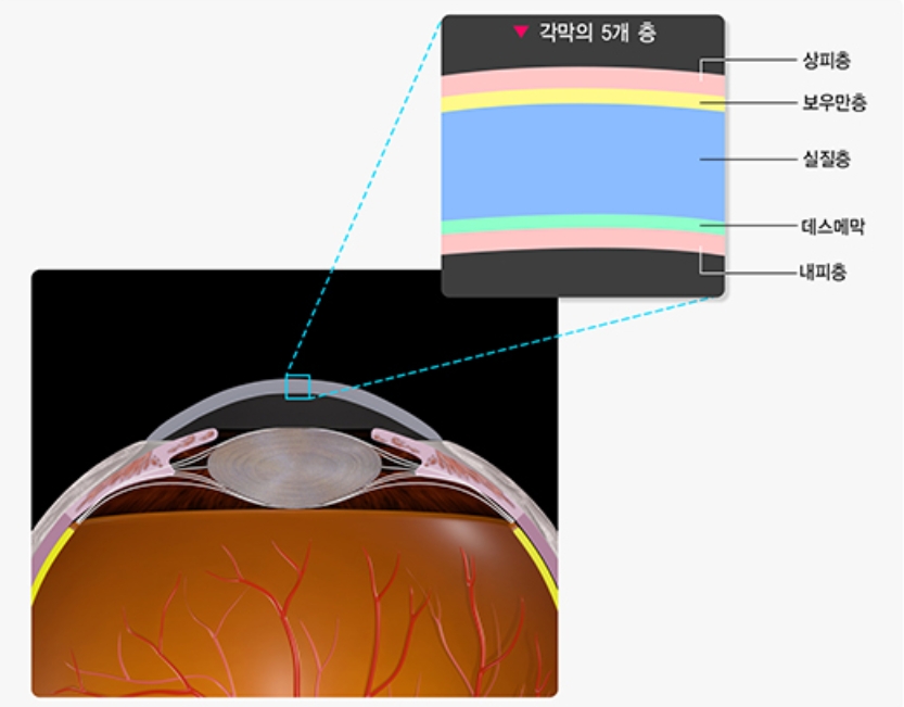 ICL 렌즈 부작용, 렌즈삽입술 후기, 각막 내피 세포, 렌즈삽입술 부작용, 렌즈삽입술 가격