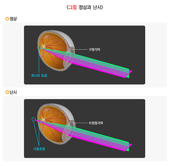 스마일 라식 난시, 난시 뜻, 난시 빛번짐, 난시 심해지는 이유, 난시 고치는 법