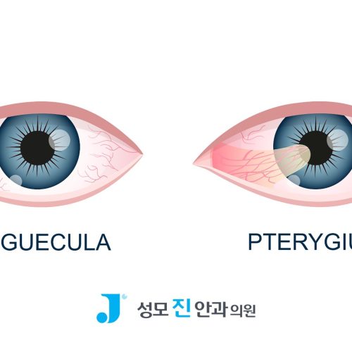 눈 흰자에 노란 혹? 익상편 vs 검열반 차이 3가지 알아보기