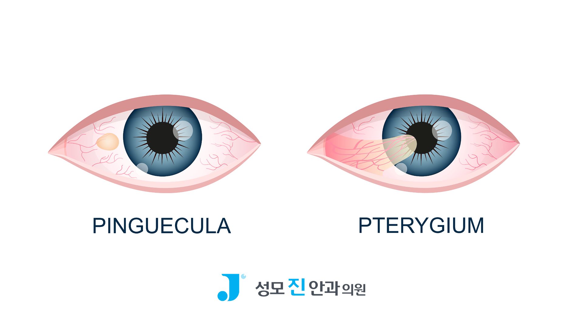 눈 흰자에 노란 혹? 익상편 vs 검열반 차이 3가지 알아보기