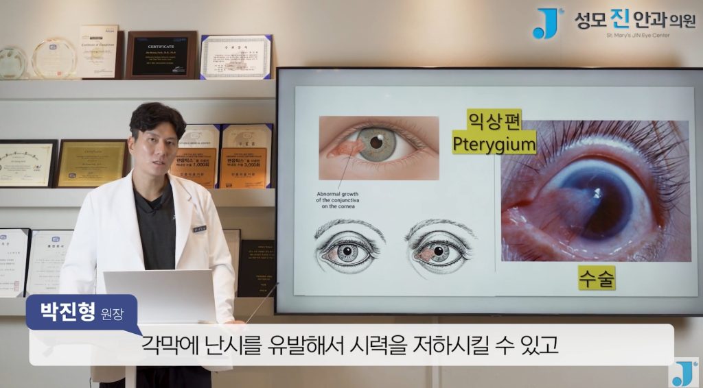 익상편, 검열반, 군날개, 눈 흰자 노란색, 눈에 이물감