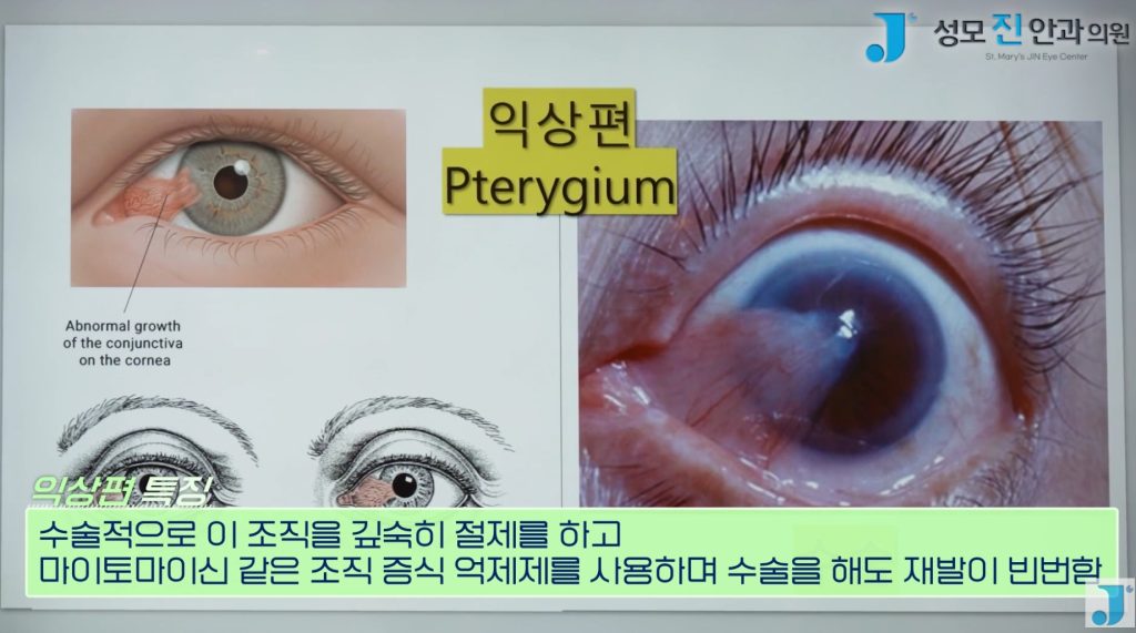 익상편, 검열반, 군날개, 눈 흰자 노란색, 눈에 이물감