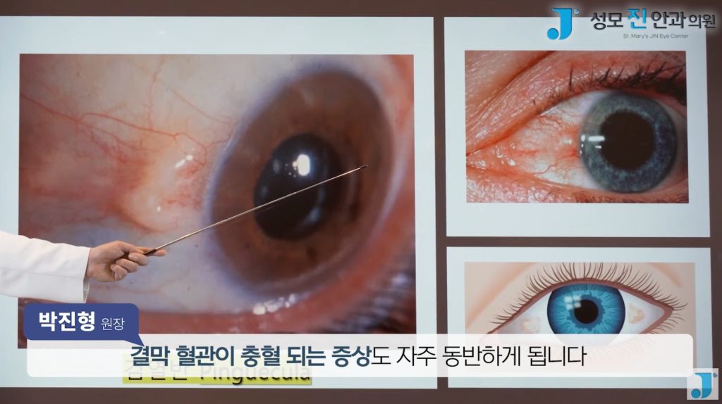 익상편, 검열반, 군날개, 눈 흰자 노란색, 눈에 이물감
