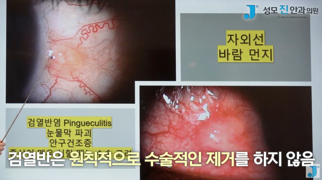 익상편, 검열반, 군날개, 눈 흰자 노란색, 눈에 이물감