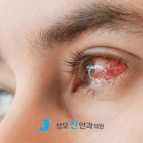 포도막염 증상과 원인 3가지, 방치하면 실명 위험까지!